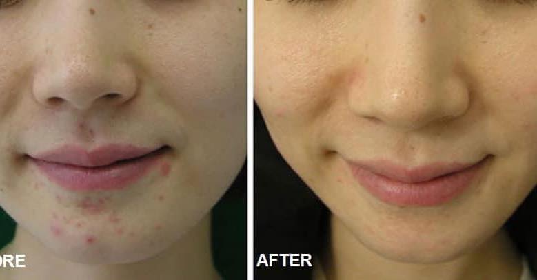 Mantra Esthetics Micro Needling BeforeandAfterCollage